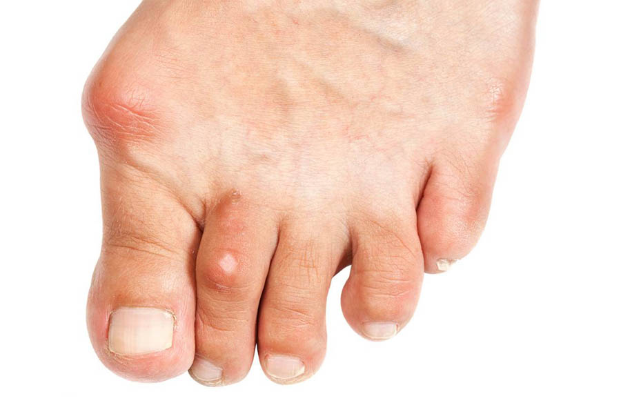 Bệnh Gout Hay Bệnh Gút Là Gì? Nguyên Nhân Và Cách Điều Trị Bệnh Gout