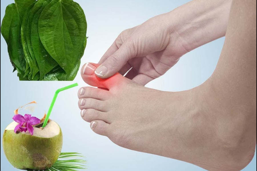 15 Cách Chữa Bệnh Gout Bằng Thuốc Nam Đơn Giản, Dễ Tìm