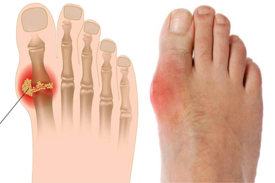 15 Cách Chữa Bệnh Gout Tại Nhà Siêu Hiệu Quả