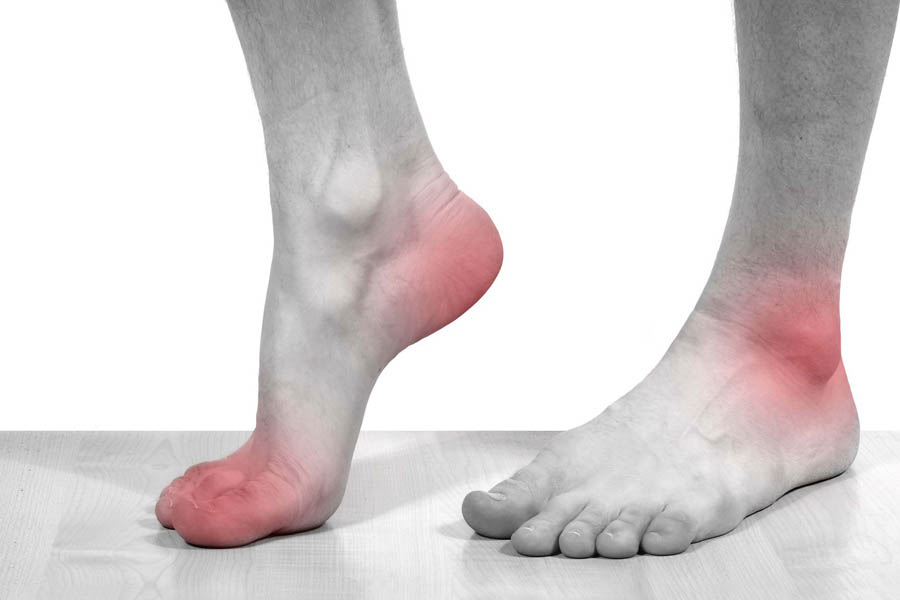 15 Cách Chữa Bệnh Gout Tại Nhà Siêu Hiệu Quả