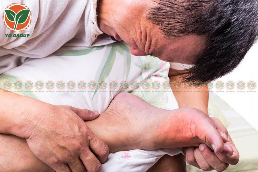 Bật Mí 9 Cách Phòng Ngừa Bệnh Gout Được Chuyên Gia Khuyên Dùng
