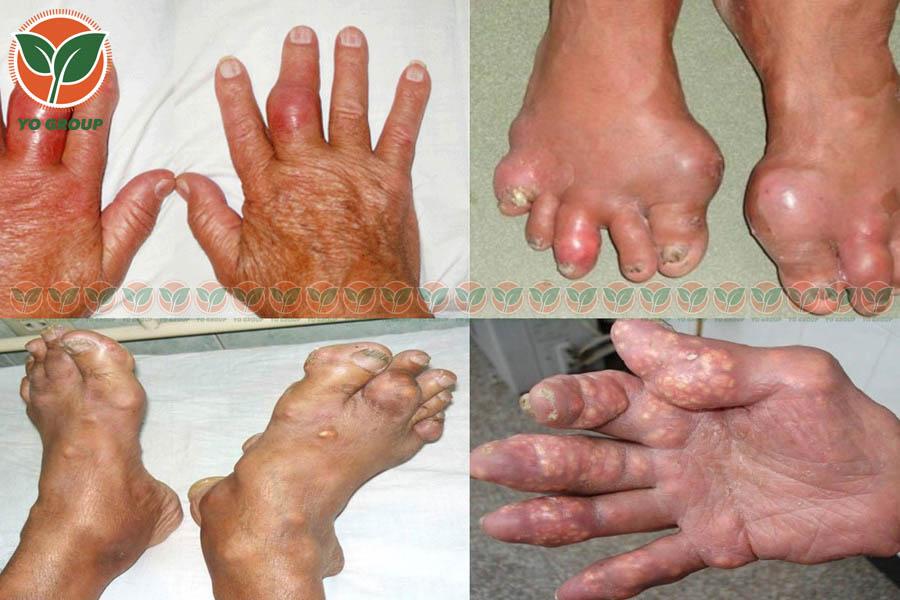 Bật Mí 9 Cách Phòng Ngừa Bệnh Gout Được Chuyên Gia Khuyên Dùng