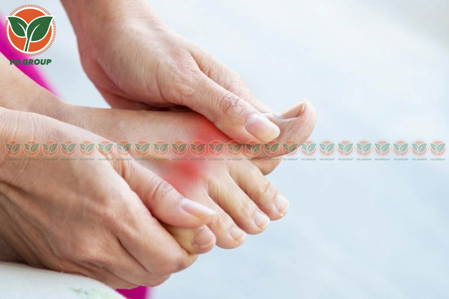 Bật Mí 9 Cách Phòng Ngừa Bệnh Gout Được Chuyên Gia Khuyên Dùng