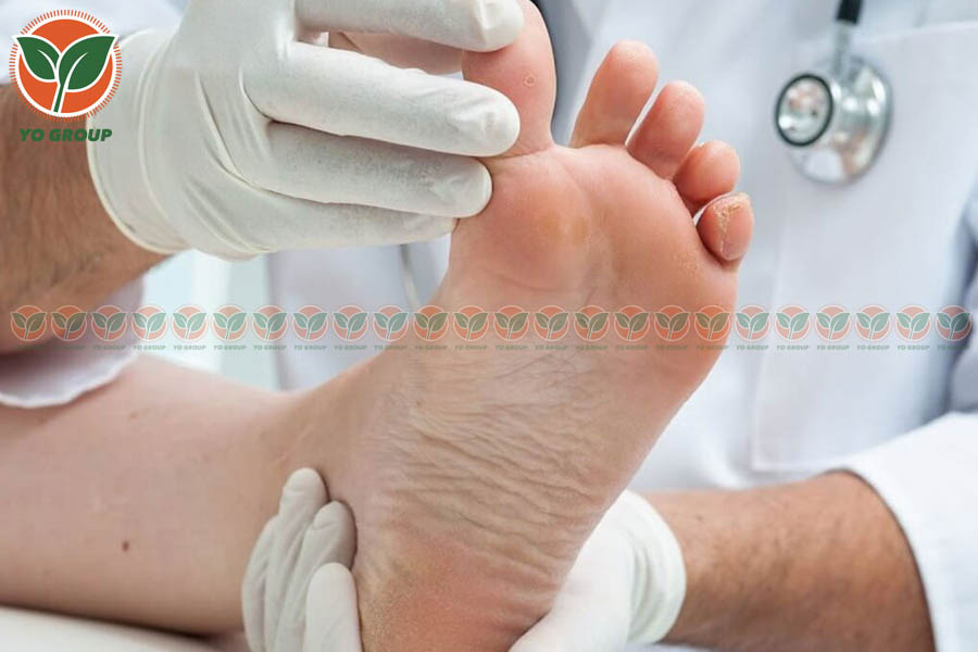 Bật Mí 9 Cách Phòng Ngừa Bệnh Gout Được Chuyên Gia Khuyên Dùng