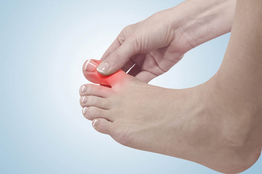 Bệnh Gout Mãn Tính Và Tất Tần Tật Thông Tin Mà Bạn Cần Biết 2 Bệnh Gout Mãn Tính Và Tất Tần Tật Thông Tin Mà Bạn Cần Biết