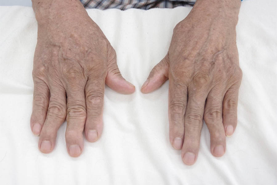 Bệnh Gout Mãn Tính Và Tất Tần Tật Thông Tin Mà Bạn Cần Biết 4 Bệnh Gout Mãn Tính Và Tất Tần Tật Thông Tin Mà Bạn Cần Biết