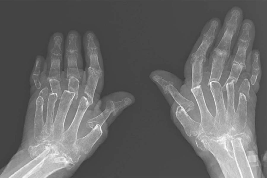 Bệnh Gout Mãn Tính Và Tất Tần Tật Thông Tin Mà Bạn Cần Biết 9 Bệnh Gout Mãn Tính Và Tất Tần Tật Thông Tin Mà Bạn Cần Biết