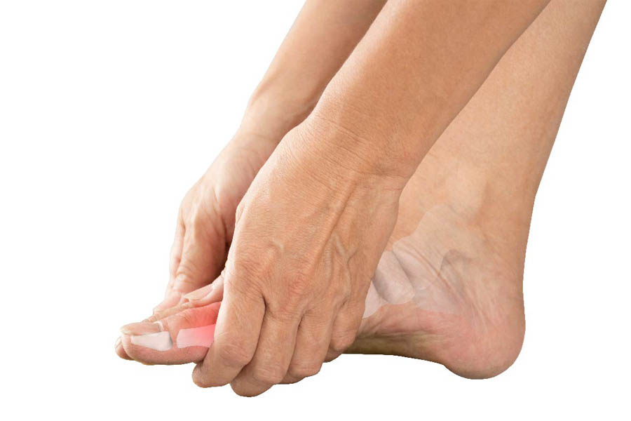 Bệnh Gout Mãn Tính Và Tất Tần Tật Thông Tin Mà Bạn Cần Biết
