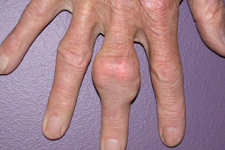 Dấu Hiệu Bệnh Gout Ở Chân Cần Lưu Ý Để Chữa Trị Kịp Thời