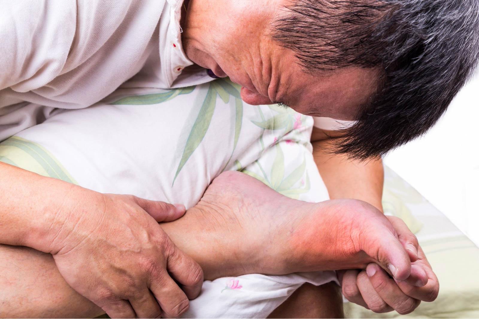 Dấu Hiệu Bệnh Gout Ở Chân Cần Lưu Ý Để Chữa Trị Kịp Thời