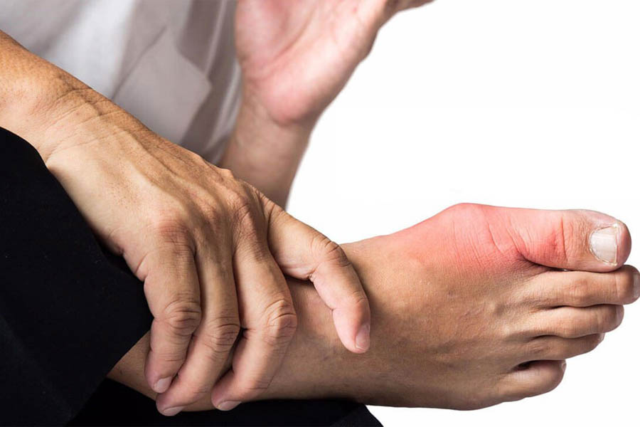 Dấu Hiệu Bệnh Gout Ở Chân Cần Lưu Ý Để Chữa Trị Kịp Thời
