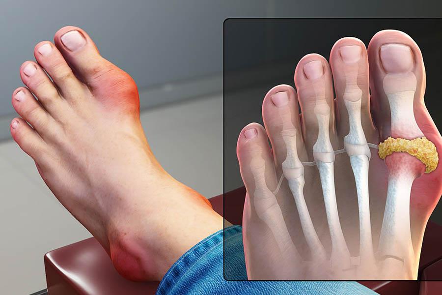 Người Bệnh Gout Nên Ăn Gì Để Cải Thiện Tình Trạng Bệnh? 2 Người Bệnh Gout Nên Ăn Gì Để Cải Thiện Tình Trạng Bệnh