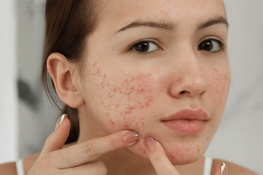 Sản phẩm Collagen Nào Tốt Cho Da Mụn 2022? 2 Sản phẩm Collagen Nào Tốt Cho Da Mụn 2022?