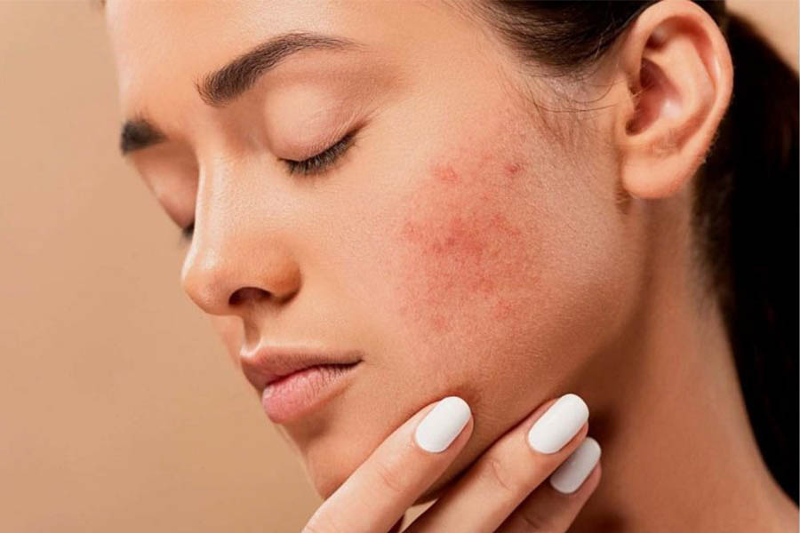 Sản phẩm Collagen Nào Tốt Cho Da Mụn 2022?