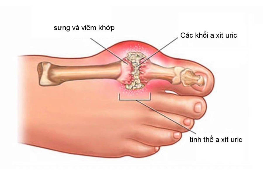 Thực Đơn Cho Người Bệnh Gout Để Hỗ Trợ Điều Trị Gout Hiệu Quả