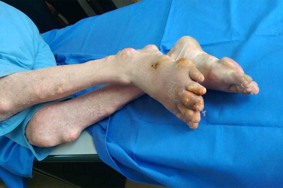 Tìm Hiểu Những Nguyên Nhân Bệnh Gout Và Biến Chứng