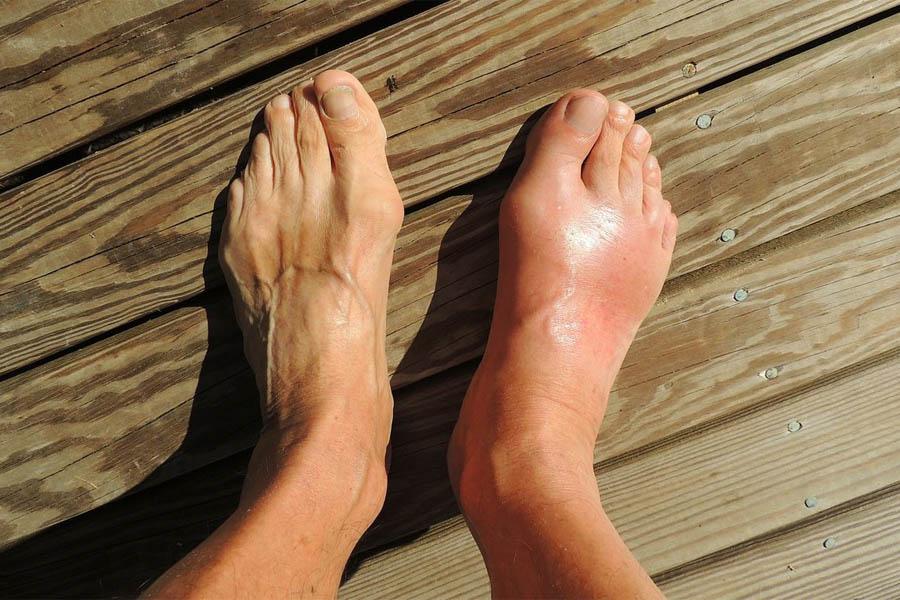 Tìm Hiểu Những Nguyên Nhân Bệnh Gout Và Biến Chứng