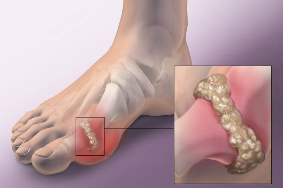 Tìm Hiểu Những Nguyên Nhân Bệnh Gout Và Biến Chứng