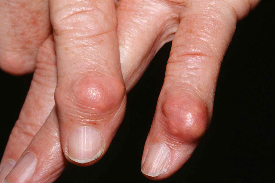 Tìm Hiểu Những Nguyên Nhân Bệnh Gout Và Biến Chứng