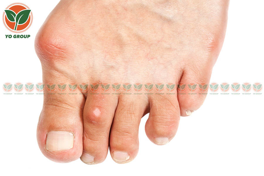 Top 8 Loại Thuốc Trị Gout Được Bác Sĩ Chỉ Định Nhiều Nhất
